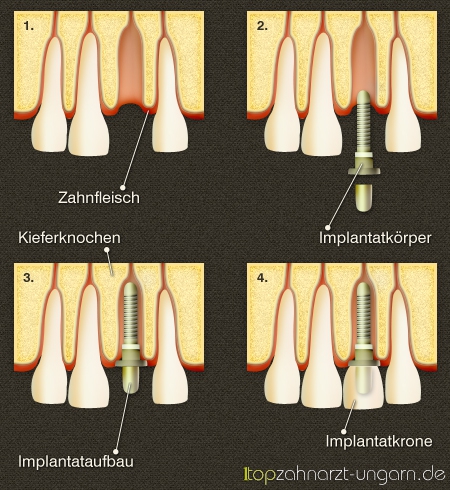 Zahnimplantate in Ungarn